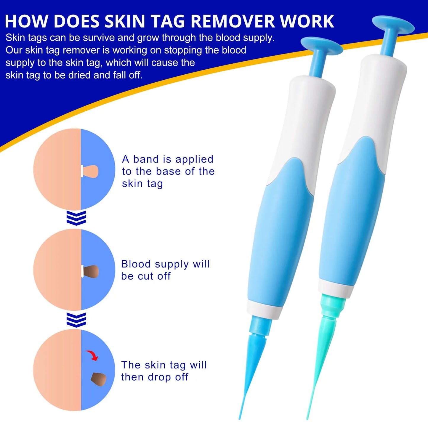 OZ Auto Skin Tag Removal Kit Painless Pen
