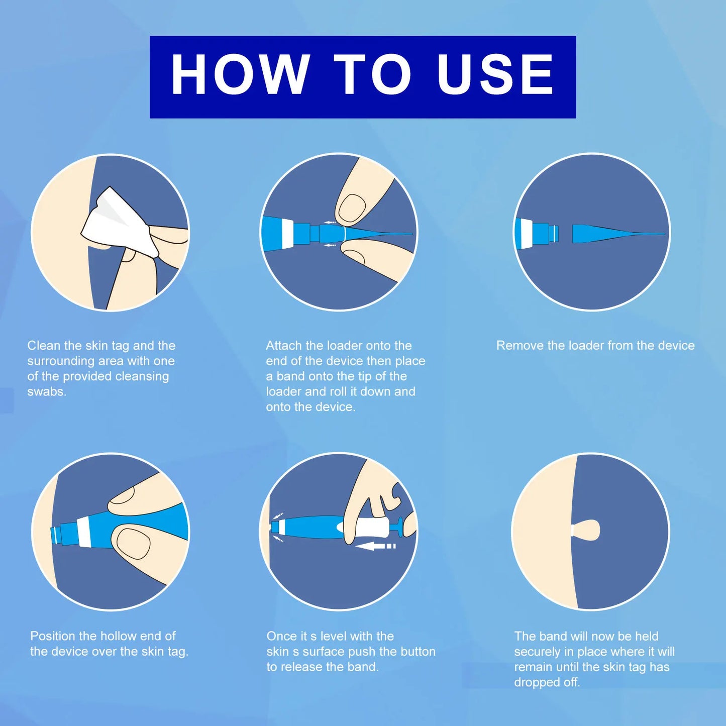 OZ Auto Skin Tag Removal Kit Painless Pen